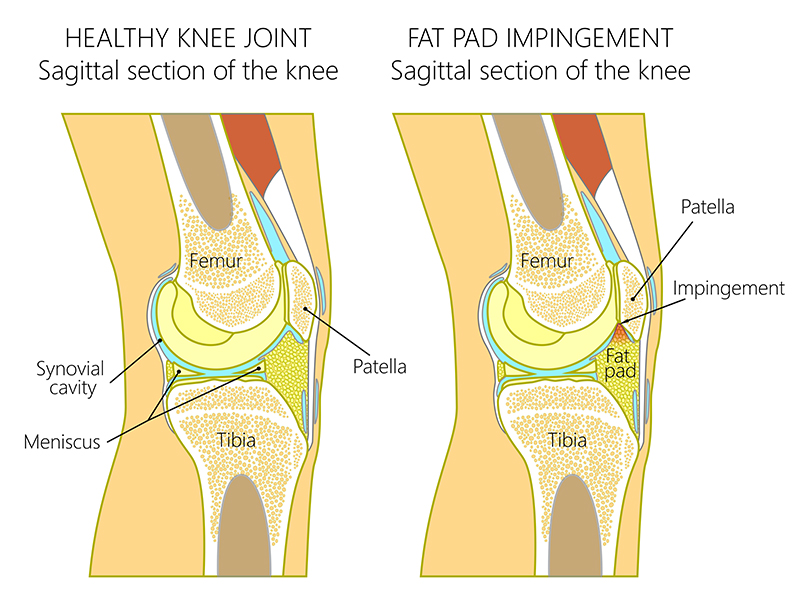 fat pad syndrome